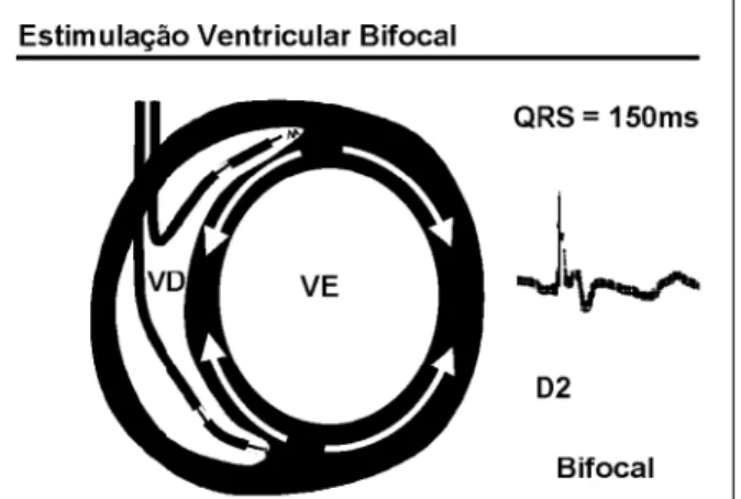 Fig.  6  - Esquema representativo da estimulação bifocal com o regis- regis-tro do QRS mais estreito resultante.