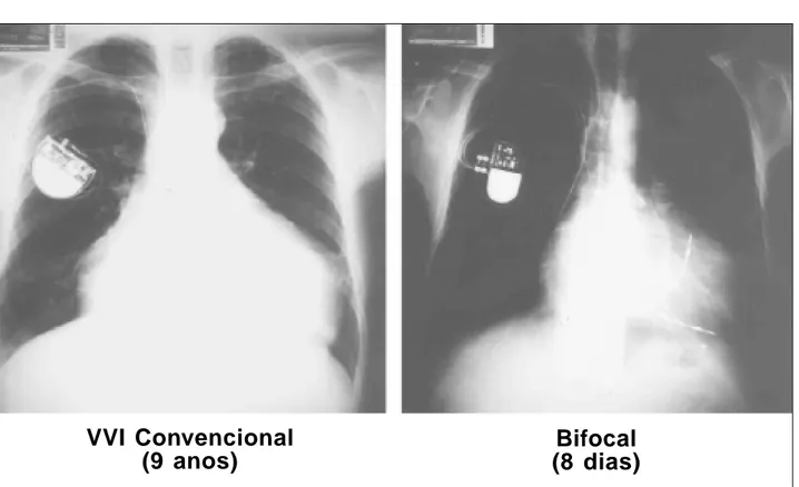 Fig.  12  - Radiografias de tórax em PA obtidas no mesmo paciente, a primeira com nove anos de evolução com estimulação ventricular convencional e, a segunda, após 8 dias de estimulação ventricular bifocal