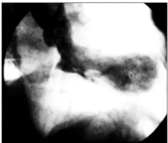 Fig. 1 - Cinecoronariografia esquerda.