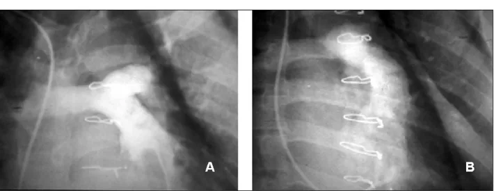 Fig.  6  - Ventriculografia direita no paciente com gradiente de pico de 66mmHg. Visualiza-se estenose tubular difusa do conduto