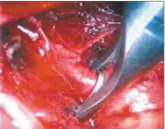 Fig. 5 - Reprodução esquemática da clipagem do canal. A - aorta, B - nervo vago, C - nervo laríngeo, D - artéria pulmonar, E - canal arterial.
