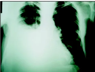 Fig. 1 - Radiografia de tórax em PA, evidenciando derrame pleural à direita.