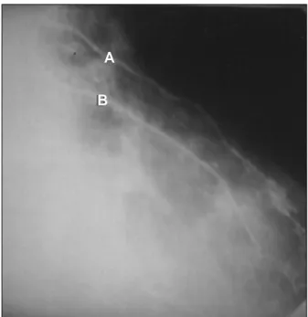 Fig. 4 – Reestudo angiográfico do paciente com 9 meses de artéria torácica interna implantada implantada