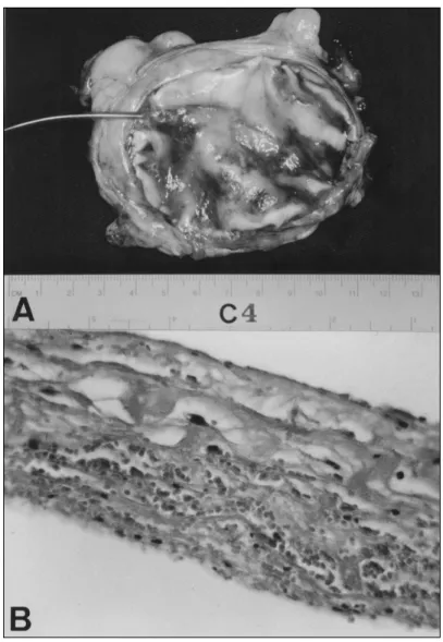 Fig. 2-A – Membrana de látex natural, neopericárdio em formação e parte do pericárdio nativo, vistos pela face interna, removidos de um animal do grupo C, 12 dias após a operação