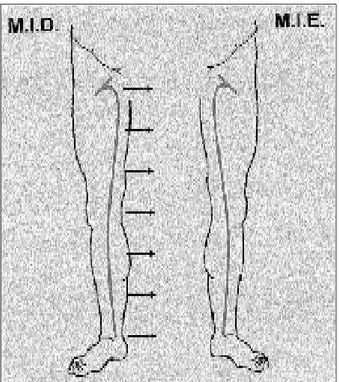 Fig. 1 - Demonstração esquemática do mapeamento da safena interna.