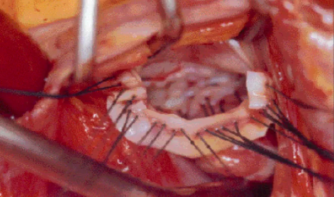 Fig.  6  – Visão cirúrgica. Anuloplastia mitral com retalho de pericárdio bovino.