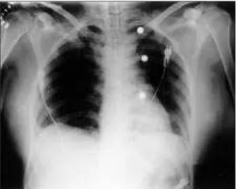 Fig. 10 – Radiografia de tórax em PA no pós-operatório com área cardíaca normal.
