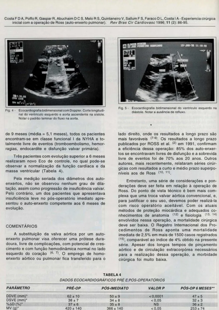 Fig . 4 - Ecocardiog rafia bidimensional com Doppler. Co rte longitudi- longitudi-nal  do  ventriculo  esquerdo  e  aorta  ascendente  na  sístole