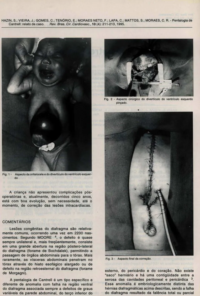 Fig.  1 - Aspecto da onfalocele e do divertículo do ventrículo esquer- esquer-do . 