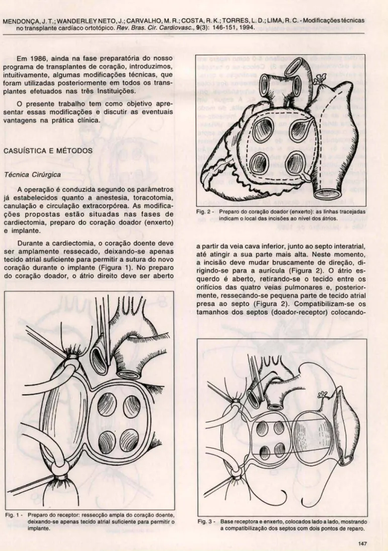 Fig.  1 - Preparo do  receptor:  ressecção  ampla  do coração doente ,  deixando-se apenas tecido atrial suficiente  para  permitir o  implante