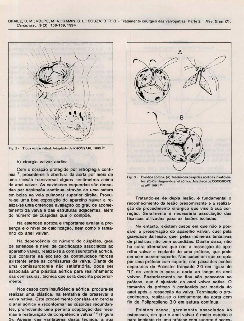 Fig . 2 - Troca valvar mitral.  Adaptado de KHONSARI , 1990 2 °. 