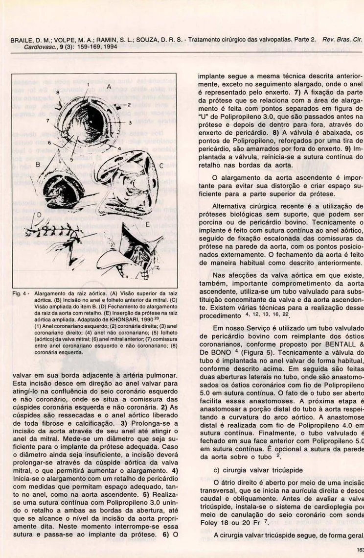 Fig . 4 - Alargamento  da  raiz  aórtica .  (A)  Visão  superior  da  raiz  aórtica . (8)  Incisão no  anel e folheto  anterior da  mitral