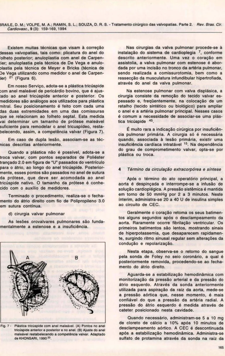 Fig . 7 - Plástica  tricúspide  com  anel  maleável.  (A)  Pontos  no  anel  tricúspide anterior e posterior e no  anel