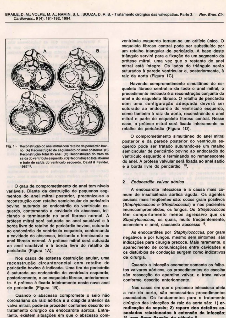 Fig . 1 - Reconstrução do anel mitral com retalho de pericárdio bovi- bovi-no. (A)  Reconstrução de seguimento do anel posterior