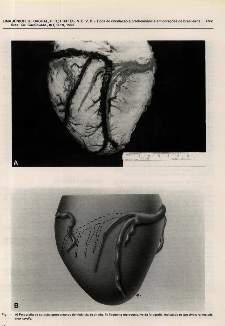 Fig .  I  - A)  Fotografia de coração apresentando dominância de direita . B)  Esquema representativo da folografia 