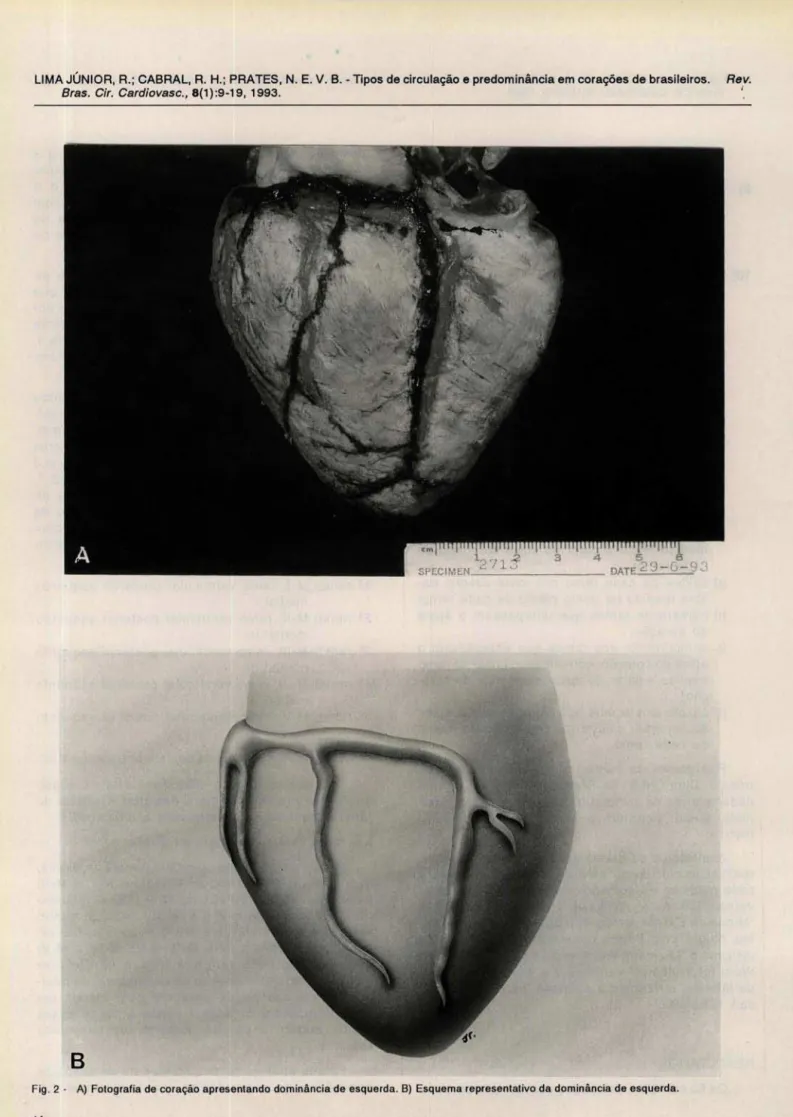Fig . 2  - A)  Fotografia de  coração apresentando dominãncia de esquerda. B)  Esquema representativo da dominância de esquerda 