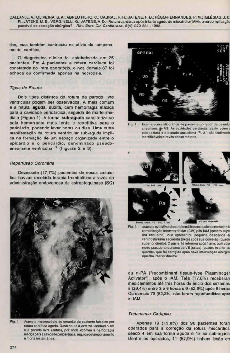 Fig . 1 - Aspecto  macroscópio do  coração  de  paciente  falecido  por  rotura cardíaca  aguda 