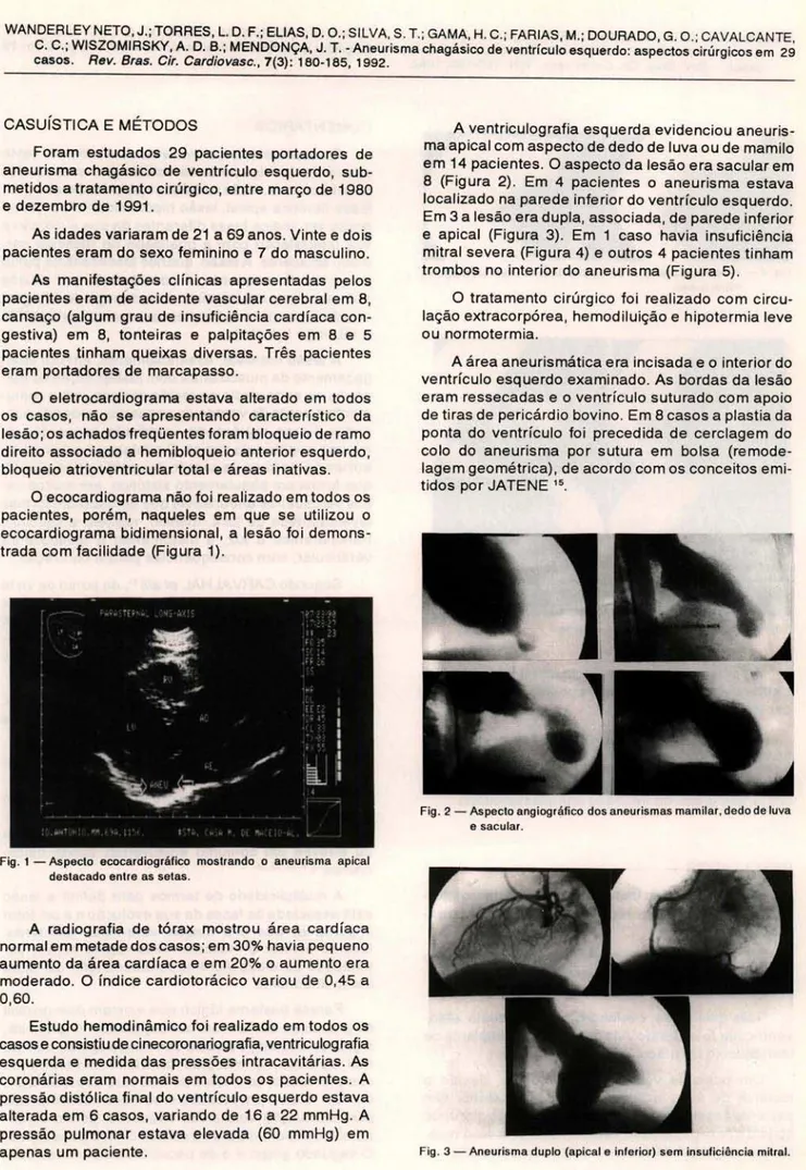 Fig . 1 - Aspec10  ecocardiográfico  mostrando  o  aneurisma  apical  destacado entre as  setas