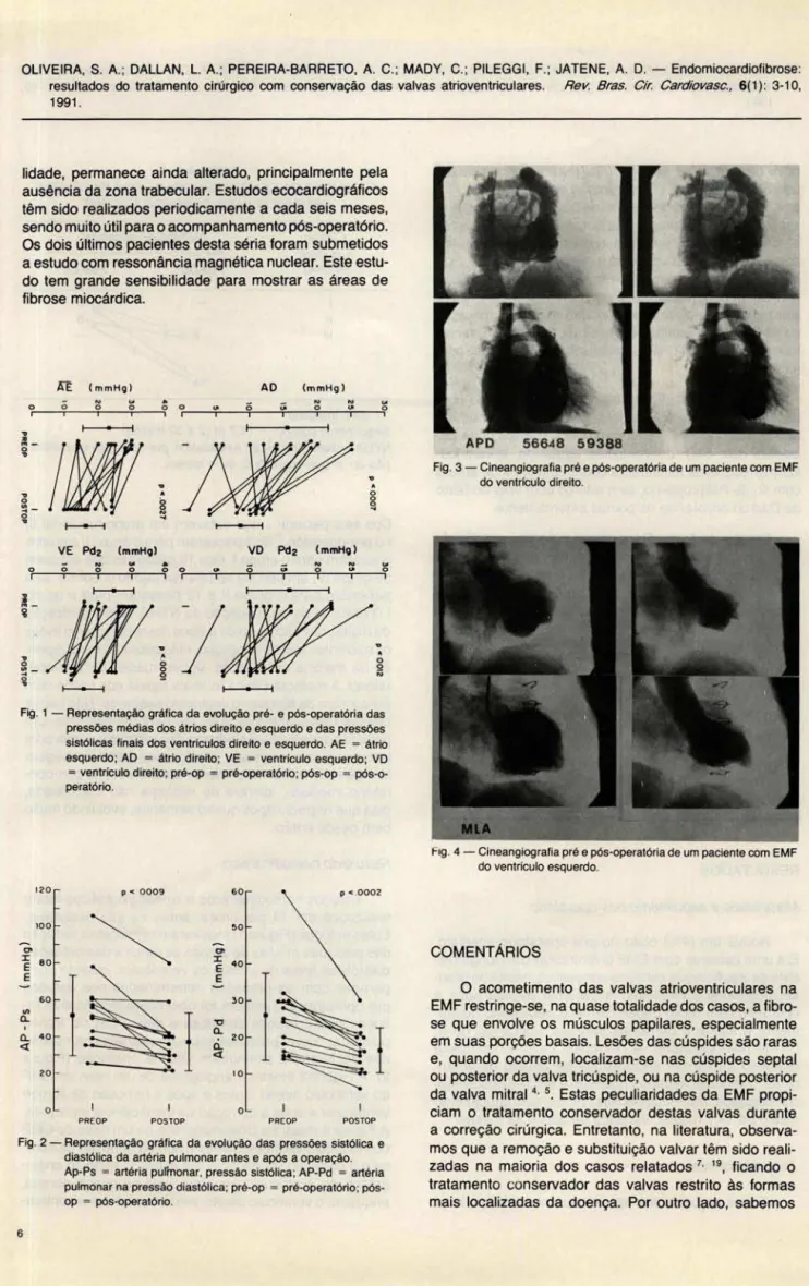 Fig. 1 - Representação  gráfica da evolução pré- e  pós-operatória das  pressões médias dos átrios direito e esquerdo e das pressões  sistólicas  finais  dos  ventrículos  dire~o  e  esquerdo