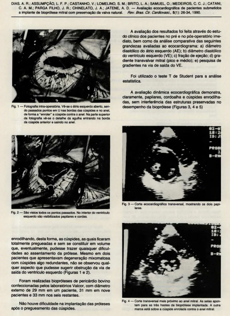 Fig . 1 - Fotografia intra-operatória. Vê-se o átrio esquerdo aberto, sen- sen-do passasen-dos pontos em U nas bórdas das cúspides e no anel,  de forma a "enrolar" a cúspide contra o anel