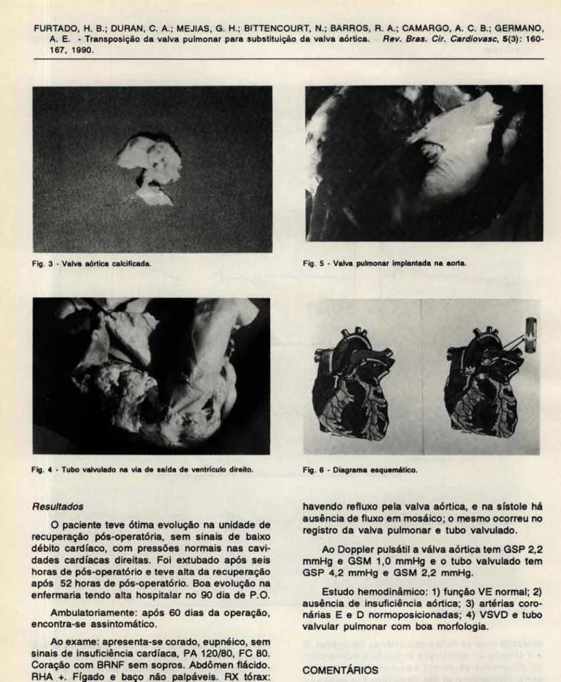 Fig .  3  •  Valva  aórtica  calcificada. 