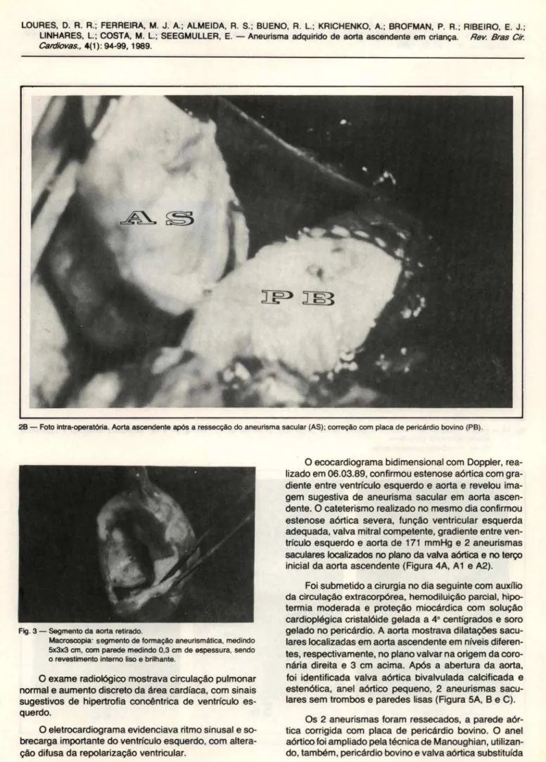 Fig.  3 - Segmento da aorta retirado. 