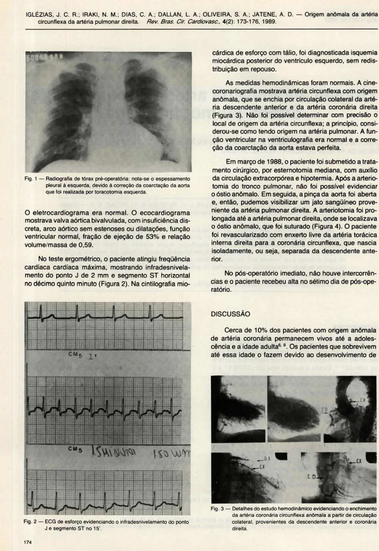 Fig . 1 - Radiografia  de tórax  pré-operatória : nota-se o espessamento  pleural  à  esquerda , devido  à  correção da  coarctação da aorta  que foi  realizada por toracotomia esquerda 