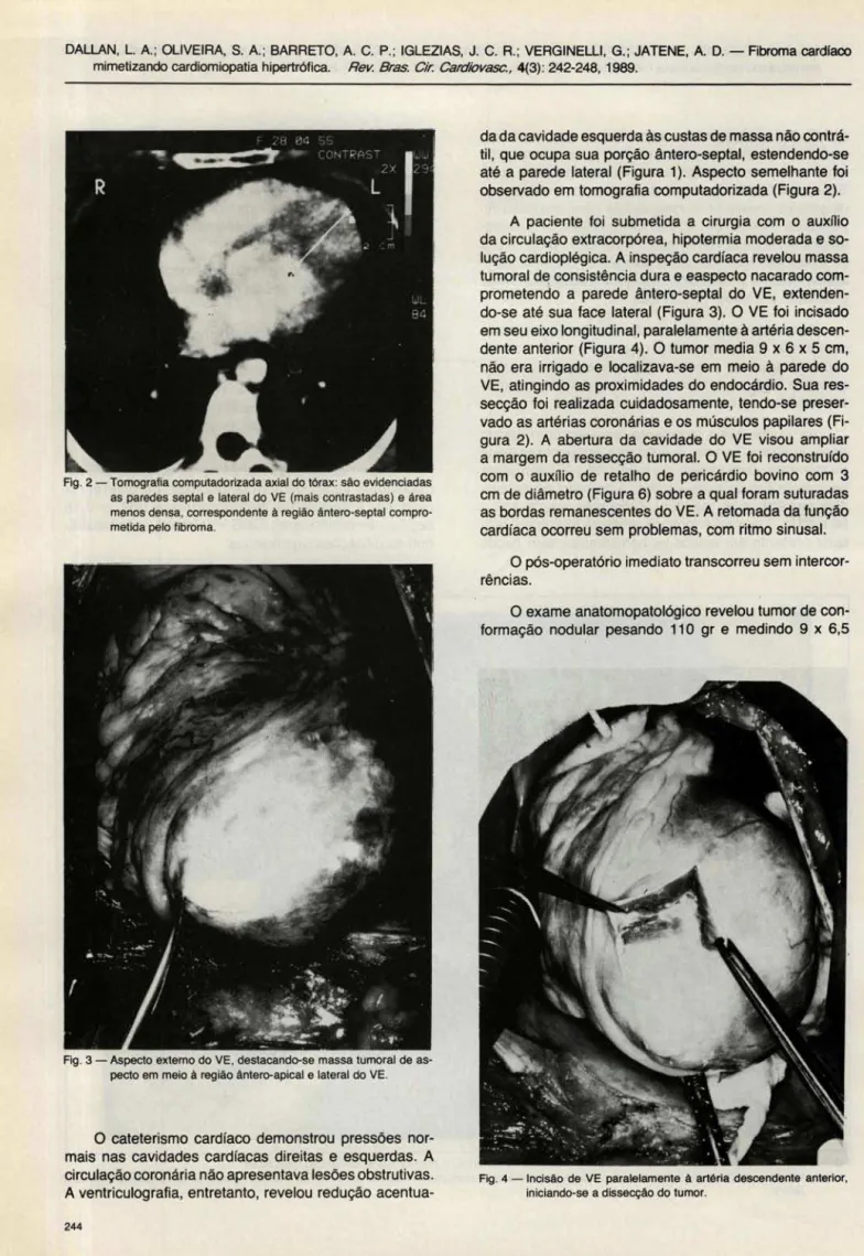 Fig . 2 - Tomografia computadorizada axial do tórax: são evidenciadas  as  paredes  septal  e  lateral  do  VE  (mais contrastadas)  e  área  menos densa , correspondente  à região ãntero-septal   compro-metida pelo fibroma
