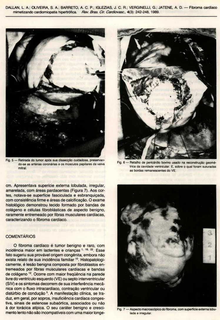 Fig . 5 - Retirada do tumor após sua dissecção cuidadosa, preservan- preservan-do-se as artéri as  coronárias e os músculos papilares da valva  mitral