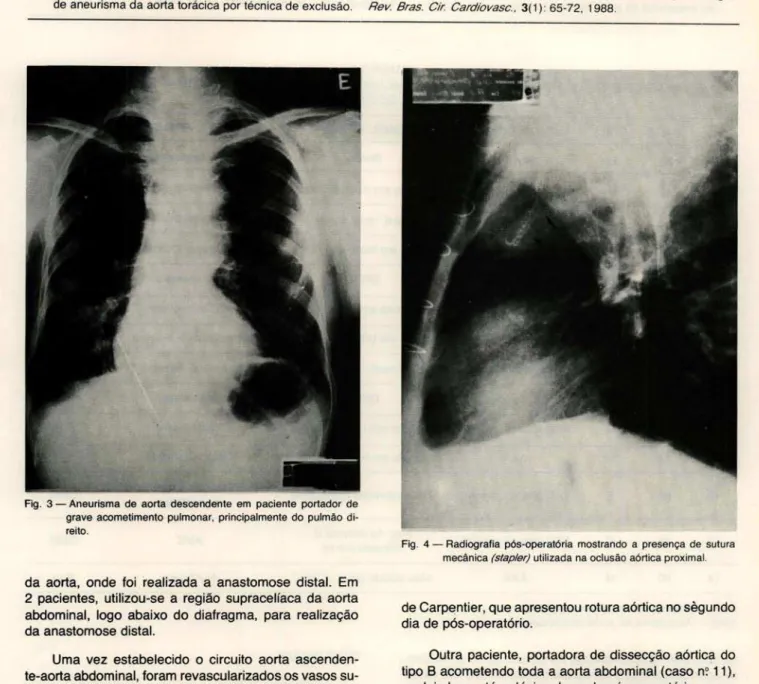 Fig .  3 - Aneurisma  de  aorta  descendente  em  paciente  portador  de  grave  acometimento  pulmonar,  principalmente  do  pulmão   di-reito 