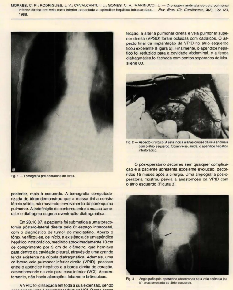 Fig . 1 - Tomografia pré-operatória do tórax . 