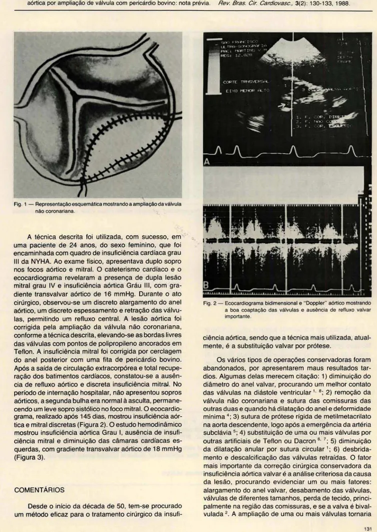 Fig . 1 - Representação esquemática mostrando a ampliação da válvula  não coronariana 