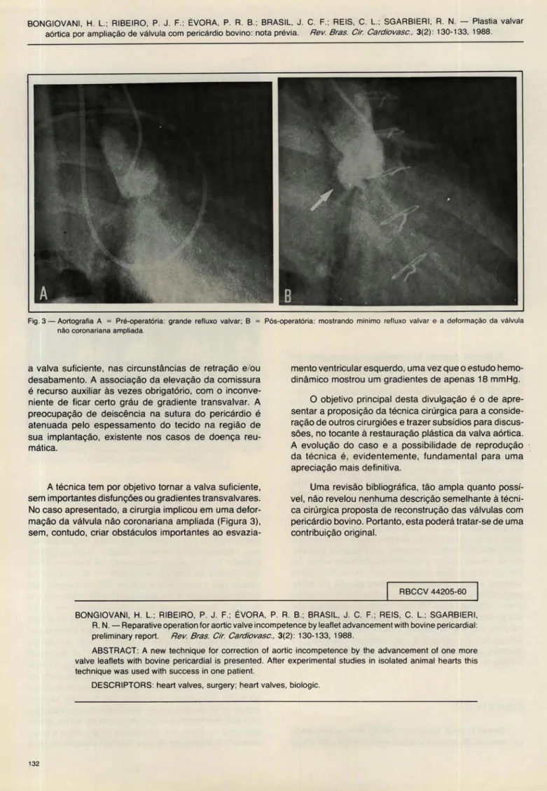 Fig . 3 - Aortografia  A  =  Pré-operatória :  grande  refluxo  valvar ;  B  =  Pós-operatória :  mostrando  mín imo  reflu xo  valva r  e  a  deform ação  da  válvula  não coronariana ampliada