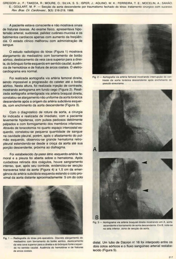 Fig . 1 - Radiografia  do tórax  pré-operatório .  Discreto  alargamento  do  mediastino  com  borramento  do  botão  aórtico ,  deslocamento  da veia cava superior para a direita e do brônquio fonte  Esquer-do  no  sentiEsquer-do  caudal