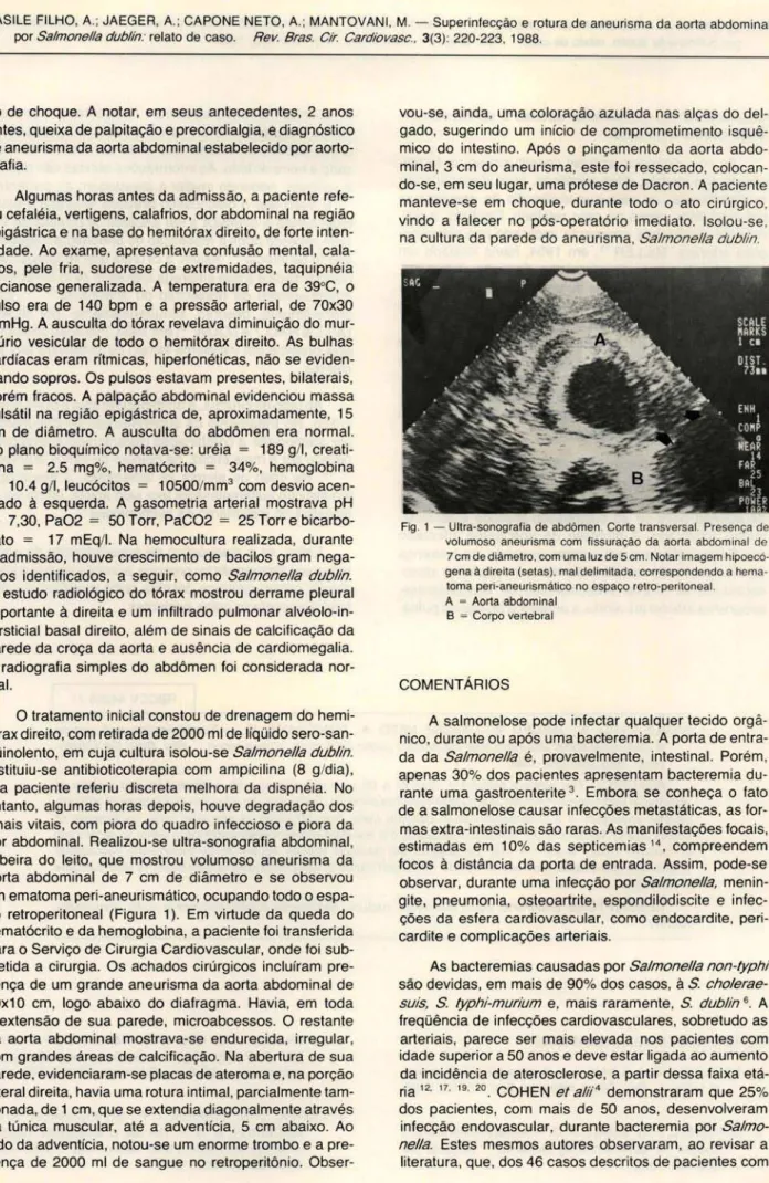 Fig.  1 - Ultra-sonografi a de abdômen . Corte transversal.  Presença  de  volumoso  aneu ri sma  com  fissuração  da  aorta  abdom inal  de  7 cm de diâmetro, com uma luz de 5 cm