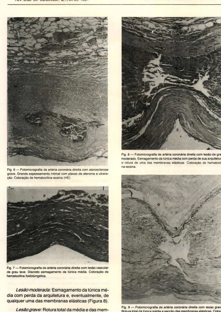 Fig . 6 - Fotomicrografia da artéria coronária direita com  aterosclerose  grave. Grande espessamento  intimai  com  placas  de ateroma  e  ulcera-ção