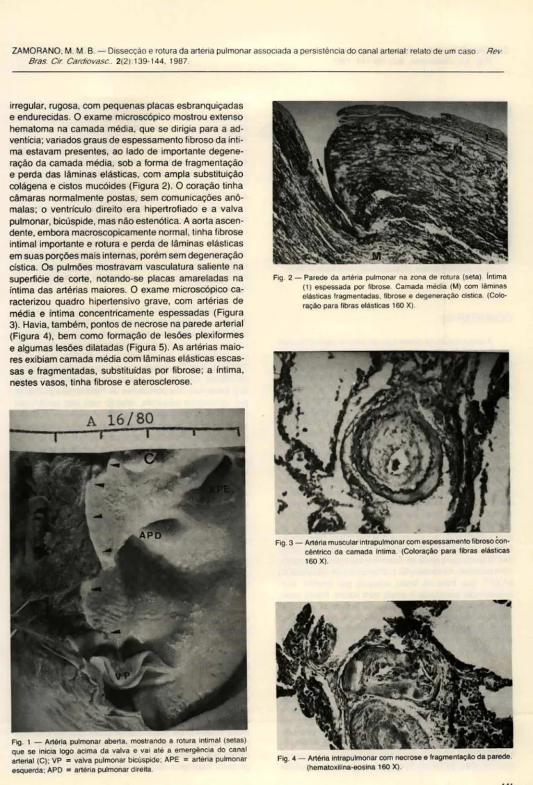 Fig .  1  - Artéria  pulmonar  aberta.  mostrando  a  rotura  intimai  (setas)  que  se  inicia  logo  acima  da  valva  e  vai  até  a  emergência  do  canal  arterial  (C);  VP  =  valva  pulmonar bicúspide ; APE  =  artéria  pulmonar  esquerda ; APD  = 