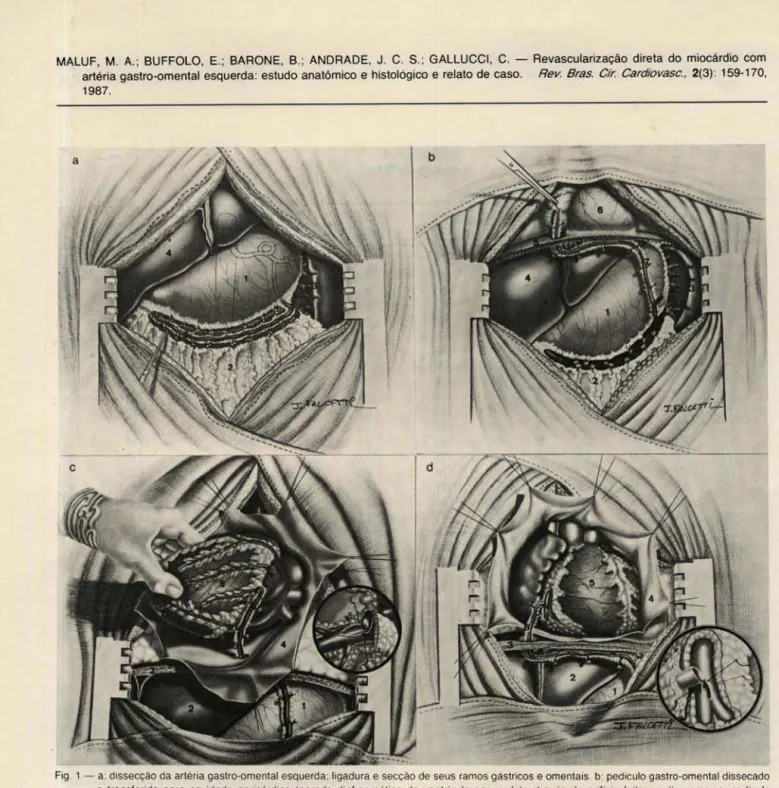 Fig . 1 - a: dissecção da  artéria gastro-omental  esquerda ; ligadura e secção de seus  ramos gástricos e omentais 
