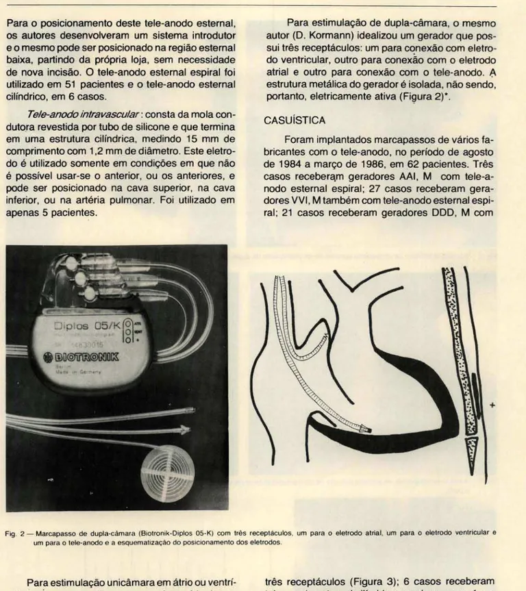 Fig .  2 - Marcapasso  de  dupla·câmara  (Biotronik· Diplos  05·Kj  com  três  receptáculos,  um  para  o  eletrodo  atrial , 'um  para  o  eletrodo  ventricular  e  um  para o  tele·anodo e  a esquematização do posicionamento dos eletrodos 