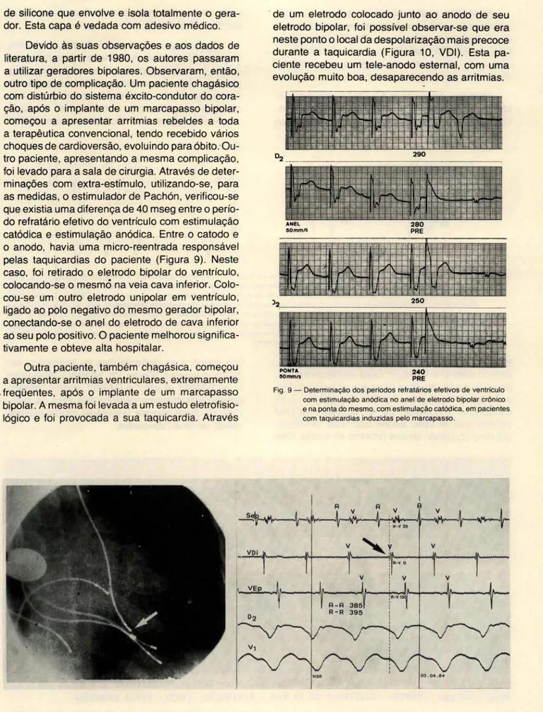 Fig . 9 - Determinação dos períodos  refratários efetivos de ventrículo  com  estimulação anódica no anel  de eletrodo bipolar crónico  e na ponta do mesmo , com estimulação catódica, em pacientes  com  taquicardias  induzidas pelo marcapasso 