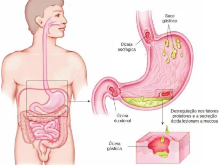 Figura  1.  Representação  esquemática  da  área  de  ocorrência  da  úlcera  péptica  (esofágica, gástrica e duodenal) (Adaptado de: &lt;http://edgarysross.soup.io&gt;) 