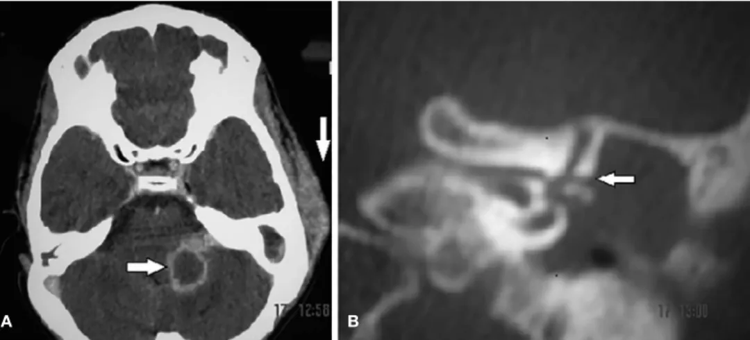 Figura 2  A, Estudo de TC axial demonstrando abscesso cerebelar e abscesso subperiosteal