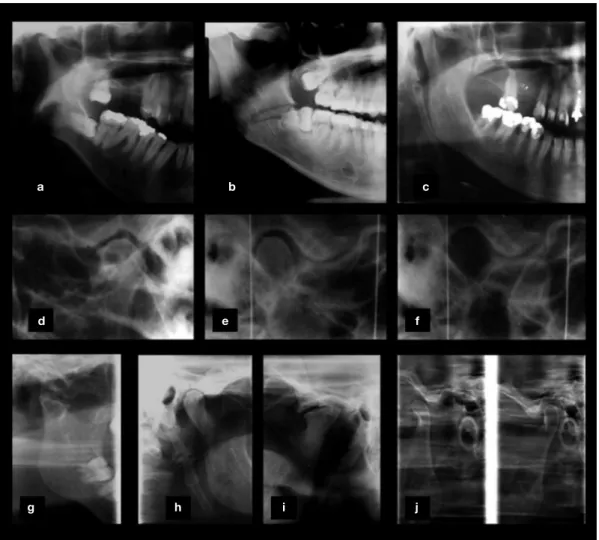 Figura 1  Exames radiográficos de diferentes ATM. (a-c) Close  em imagem panorâmica evidenciando hipoplasia da cabeça da man- man-díbula (a), impacção horizontal do terceiro molar inferior (a, b), traço de fratura na região de ângulo goníaco (b) e alongame