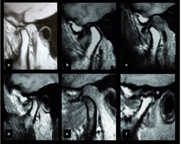 Figura 3  Diferentes IRM registrando deslocamento anterior do disco articular sem redução em cortes parassagitais