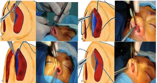 Figura 1  Sequências da sutura septocolumelar superior.