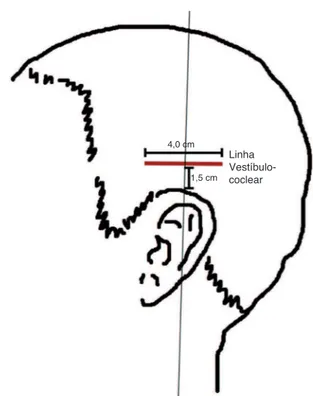 Figura 3  Linha vestibulococlear de acordo com a craniopuntu- craniopuntu-ra chinesa.