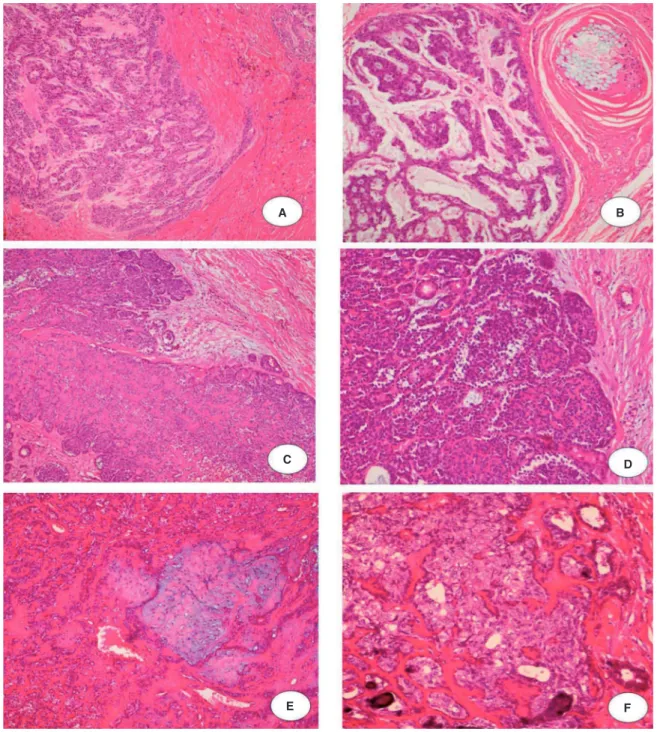 Figura 1  Carcinoma mioepitelial francamente invasivo: A, Ilha de células mioepiteliais infiltrando o tecido (H &amp; E 3 10); B, Cordões  de células mioepiteliais pleomórficas cercado por estroma mixoide