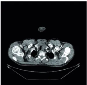 Figura 1  TC do primeiro paciente mostrando um tumor nodu- nodu-lar com calcificação distrófica.