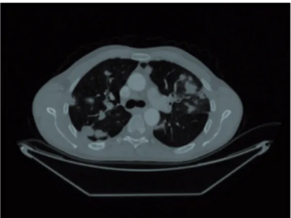 Figura 2  Múltiplos nódulos intraparenquimais e metastáticos  subpleurais no TC de tórax do primeiro paciente.