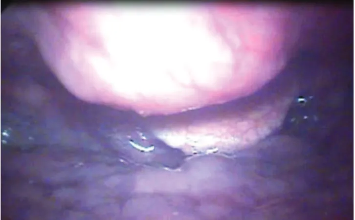 Figura 1  Imagem de videolaringoscopia de um paciente com  doença de Forestier mostrando abaulamento submucoso em  hipofaringe, correspondendo a proeminente osteófito cervical
